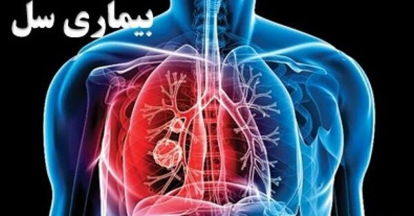 عکس ریه فرد مبتلا به سل