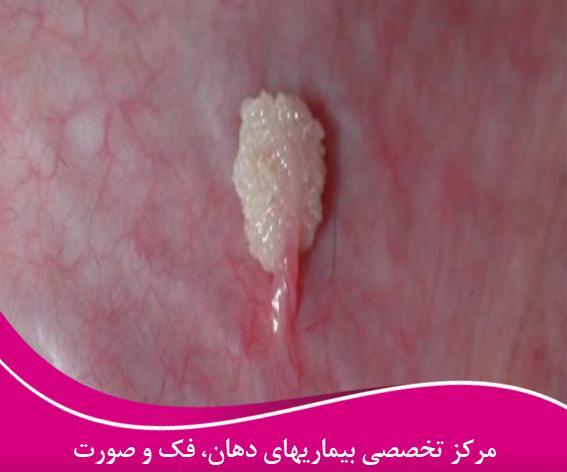 عکس تصاویر ویروس پاپیلومای انسانی