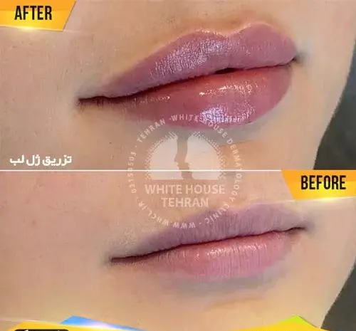 عکس ژل طبیعی