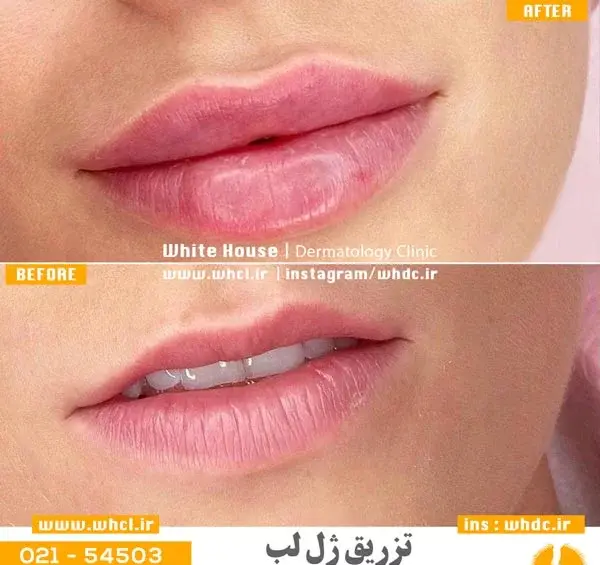 عکس ژل طبیعی