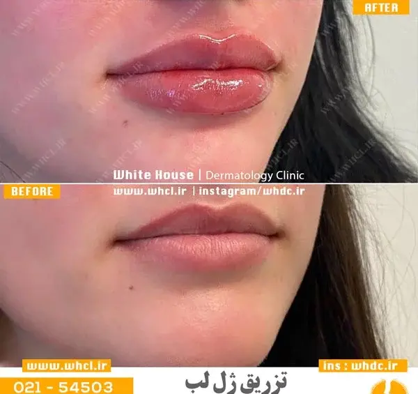 عکس ژل طبیعی
