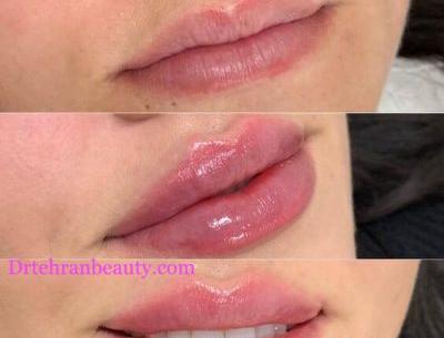عکس ژل طبیعی