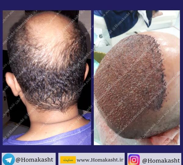 عکس جراحی کاشت مو