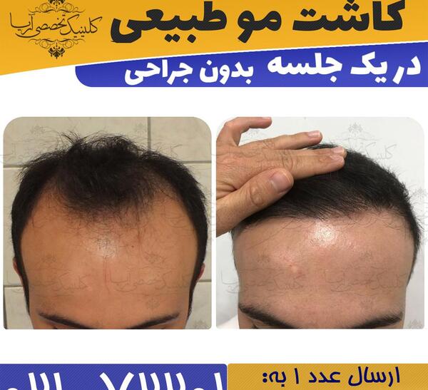 عکس جراحی کاشت مو