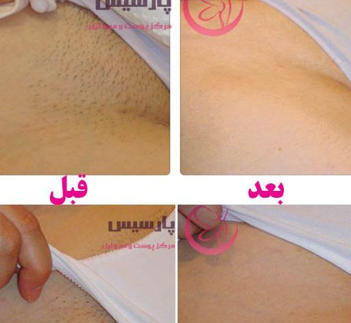 عکس لیزر موهای بیکینی
