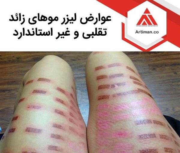 عکس لیزر موهای بیکینی