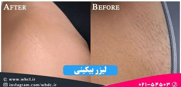 عکس لیزر موهای بیکینی