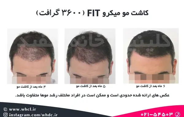 عکس کاشت مو بعد از یک هفته