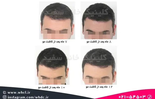 عکس کاشت مو بعد از سه ماه