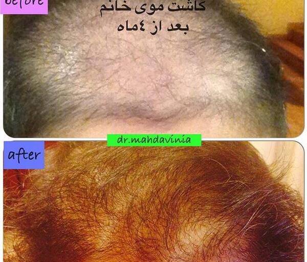 عکس کاشت مو بعد از سه ماه