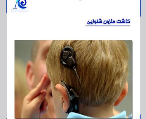 عکس کاشت حلزونی