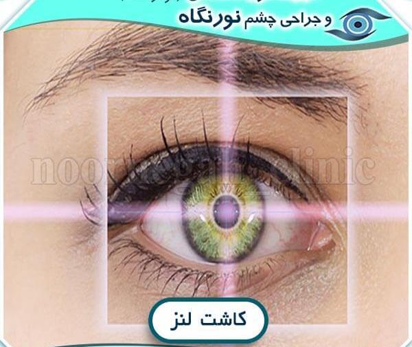 عکس کاشت لنز