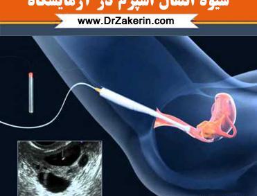 عکس کاشت جنین در رحم