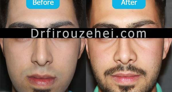 عکس جراحی فک قبل و بعد
