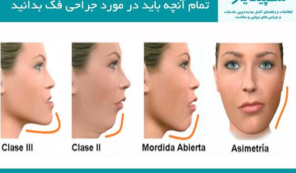 عکس جراحی فک قبل و بعد
