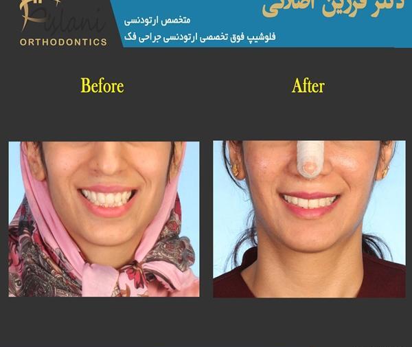 عکس جراحی فک قبل و بعد