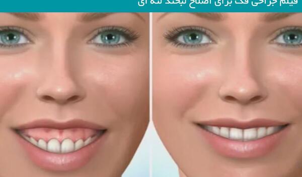 عکس جراحی فک قبل و بعد