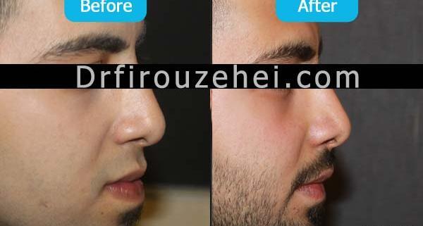 عکس جراحی فک قبل و بعد