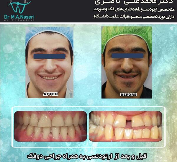 عکس جراحی فک قبل و بعد