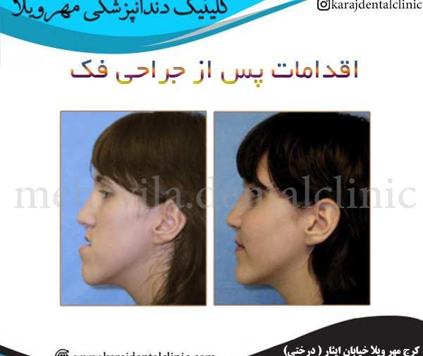 عکس جراحی فک قبل و بعد