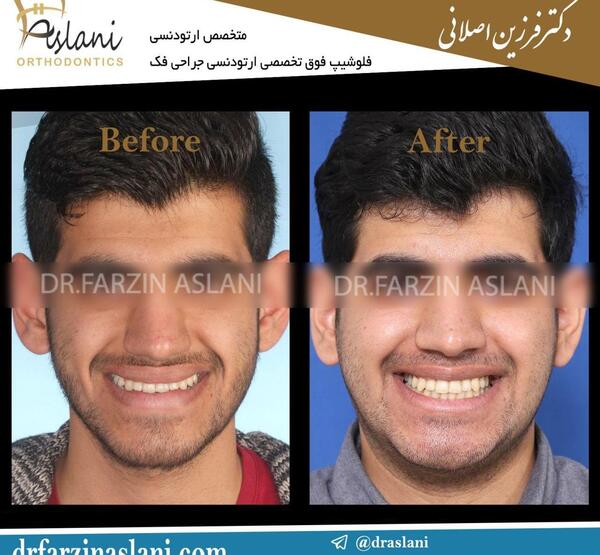 عکس جراحی فک قبل و بعد