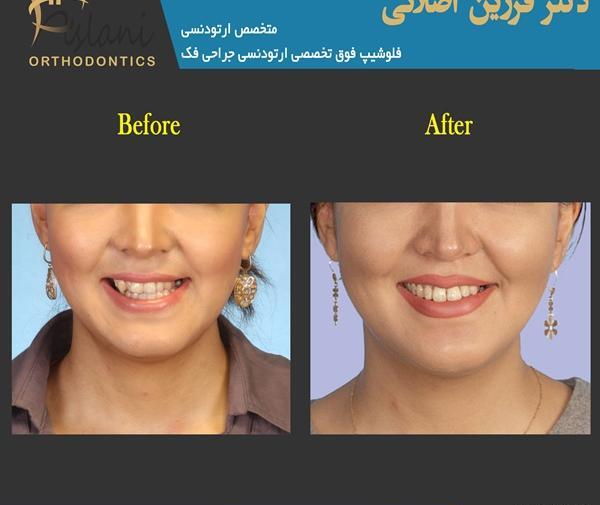 عکس جراحی فک قبل و بعد