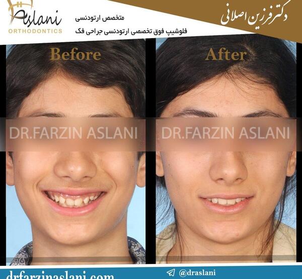 عکس جراحی فک قبل و بعد