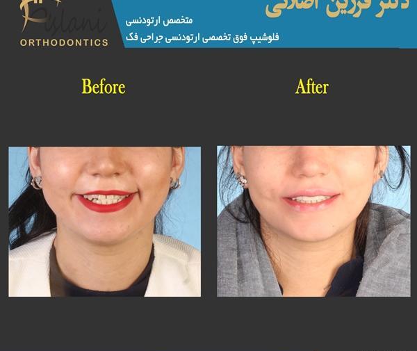 عکس جراحی فک قبل و بعد