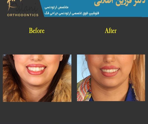 عکس جراحی فک قبل و بعد