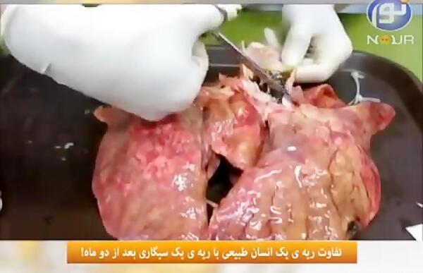 عکس ریه آدم