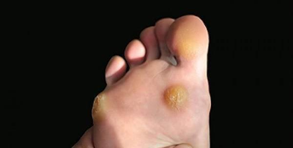 عکس ریشه میخچه