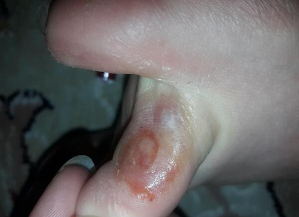 عکس ریشه میخچه