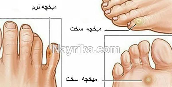 عکس ریشه میخچه