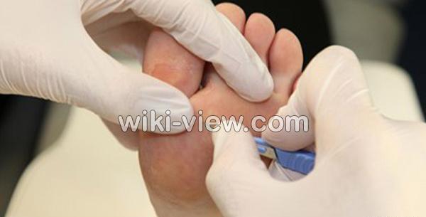 عکس ریشه میخچه