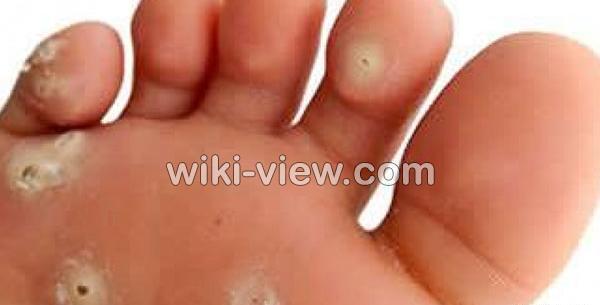 عکس ریشه میخچه