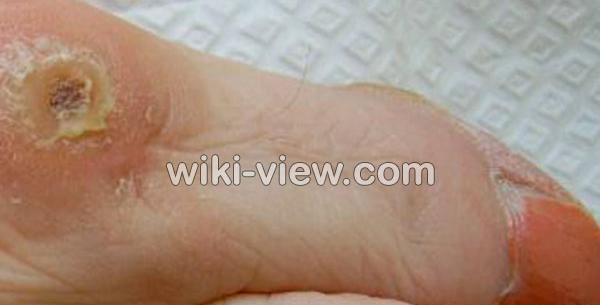 عکس ریشه میخچه