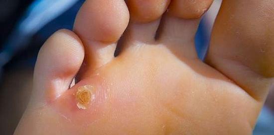 عکس ریشه میخچه