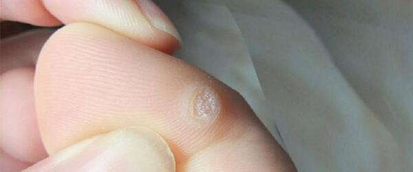 عکس ریشه میخچه