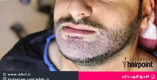 عکس کاشت ریش