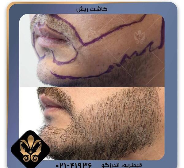 عکس کاشت ریش