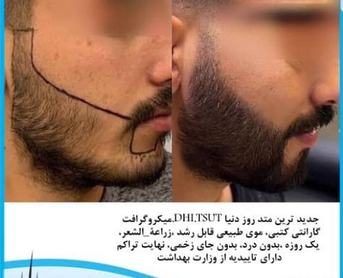 عکس کاشت ریش