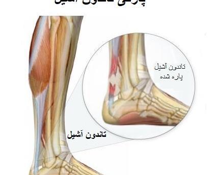 عکس ام ار ای پارگی رباط مچ پا