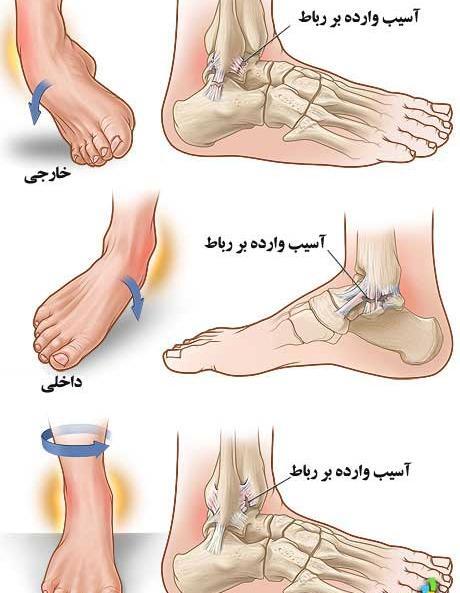 عکس ام ار ای پارگی رباط مچ پا