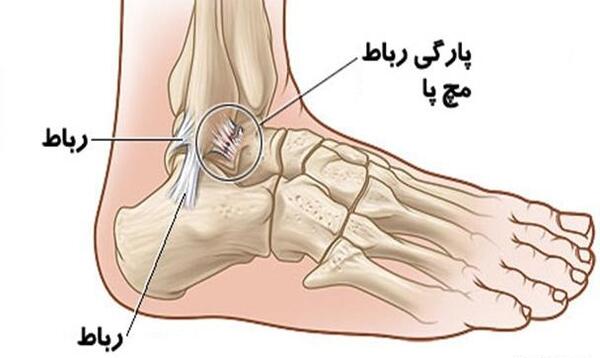 عکس ام ار ای پارگی رباط مچ پا