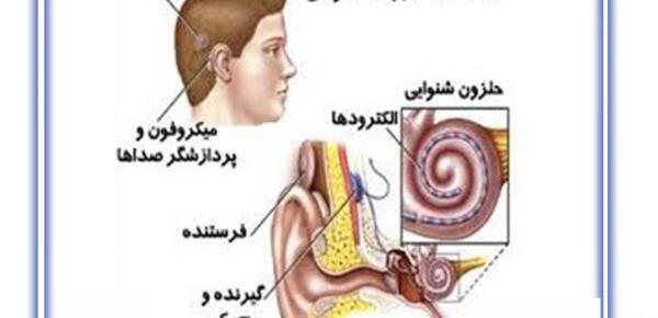 عکس کاشت حلزون