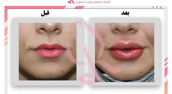 عکس لب طبیعی