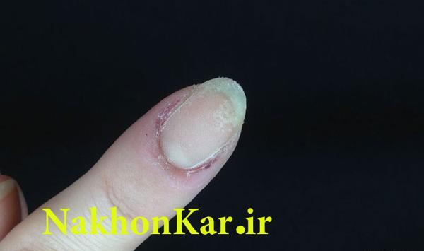 عکس ناخن آسیب دیده