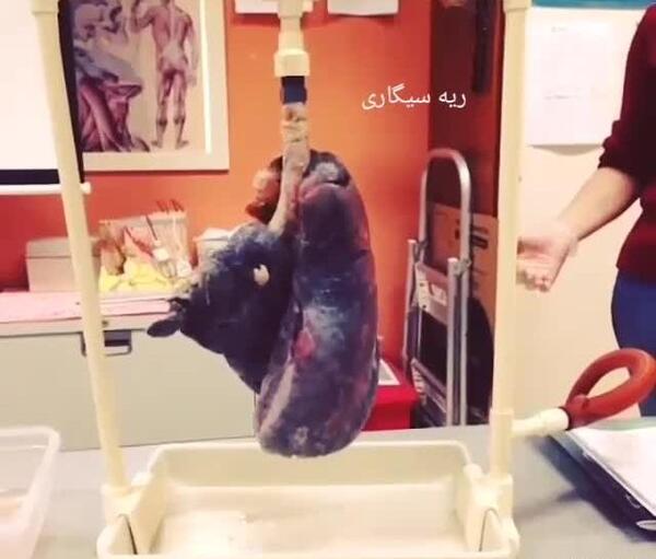 عکس ریه فرد قلیانی