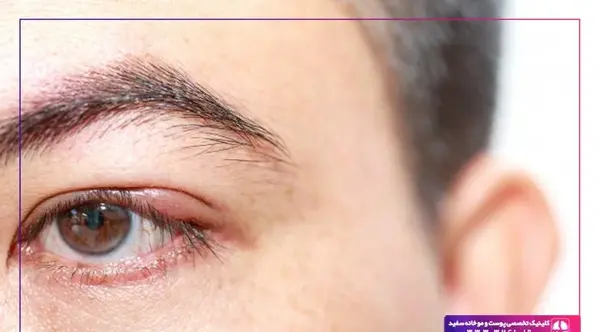 عکس شپش در چشم