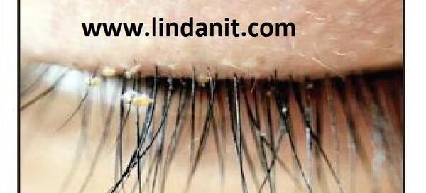 عکس شپش در چشم